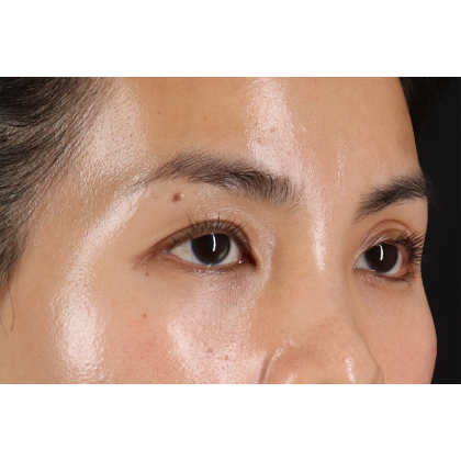 Blepharoplasty (Eyelid Surgery) Before & After Patient #10782