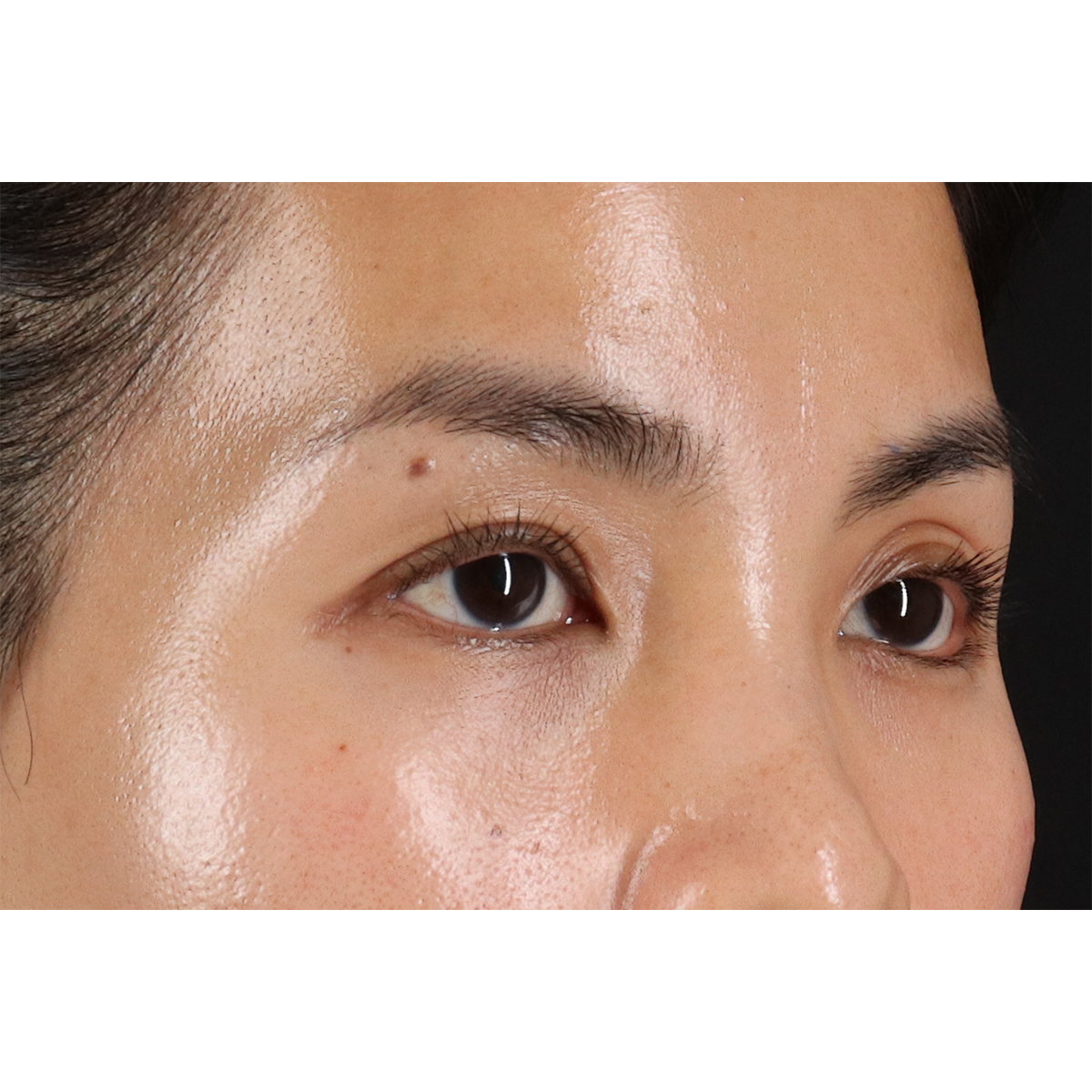 Blepharoplasty (Eyelid Surgery) Before & After Patient #10782
