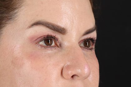 Rhinoplasty Before & After Patient #12656
