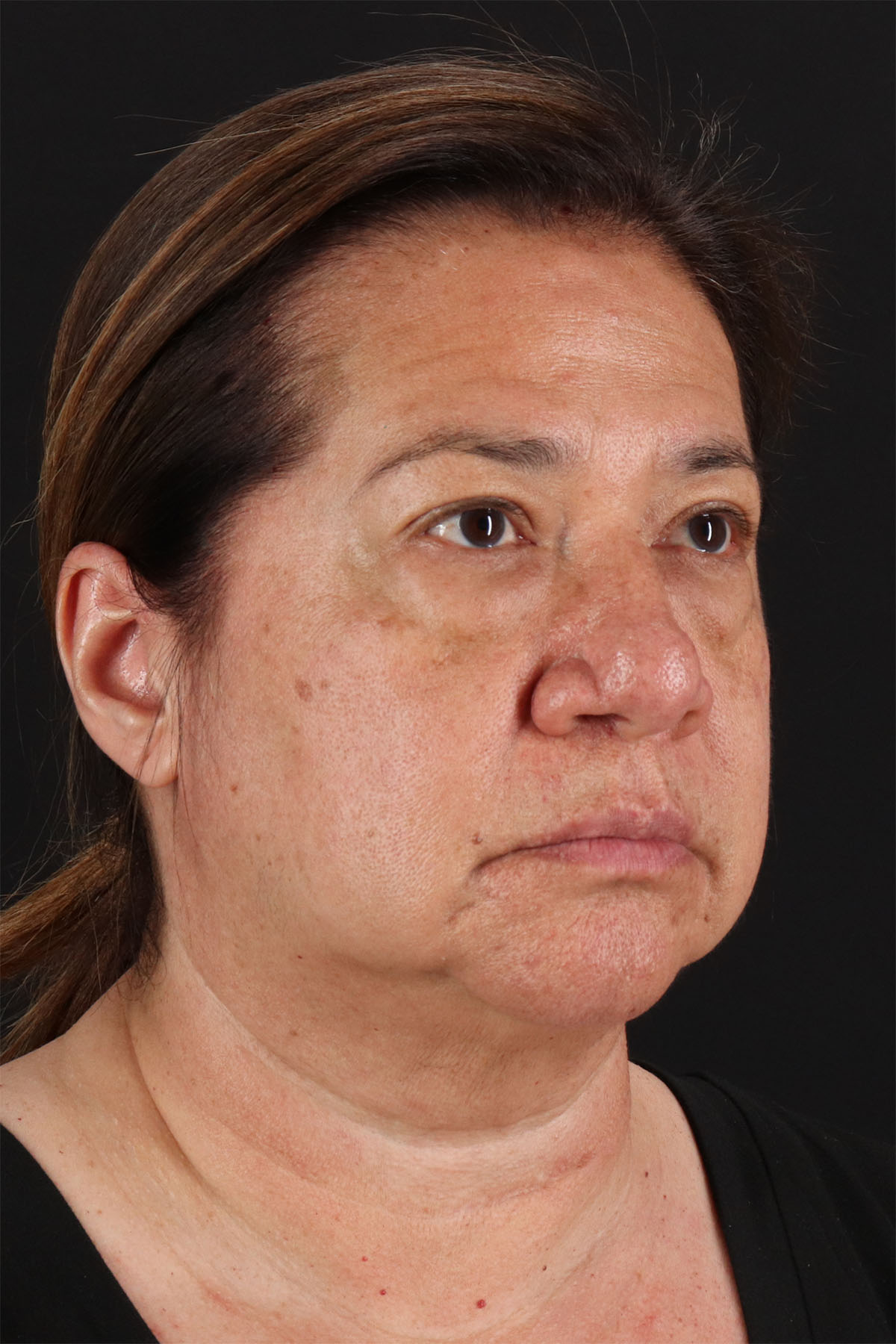 CO2 Laser Before & After Patient #11136