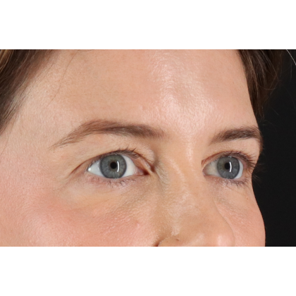 Blepharoplasty (Eyelid Surgery) Before & After Patient #11517