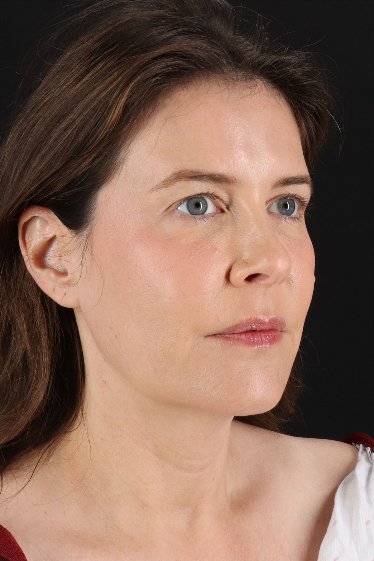 Fat Grafting To The Face Before & After Patient #11817