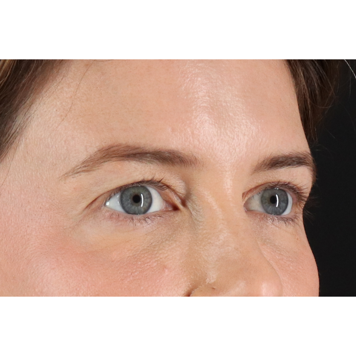 Blepharoplasty (Eyelid Surgery) Before & After Patient #11517