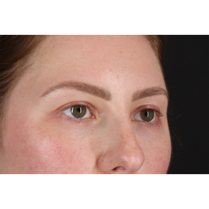 Brow Lift Before & After Patient #11657