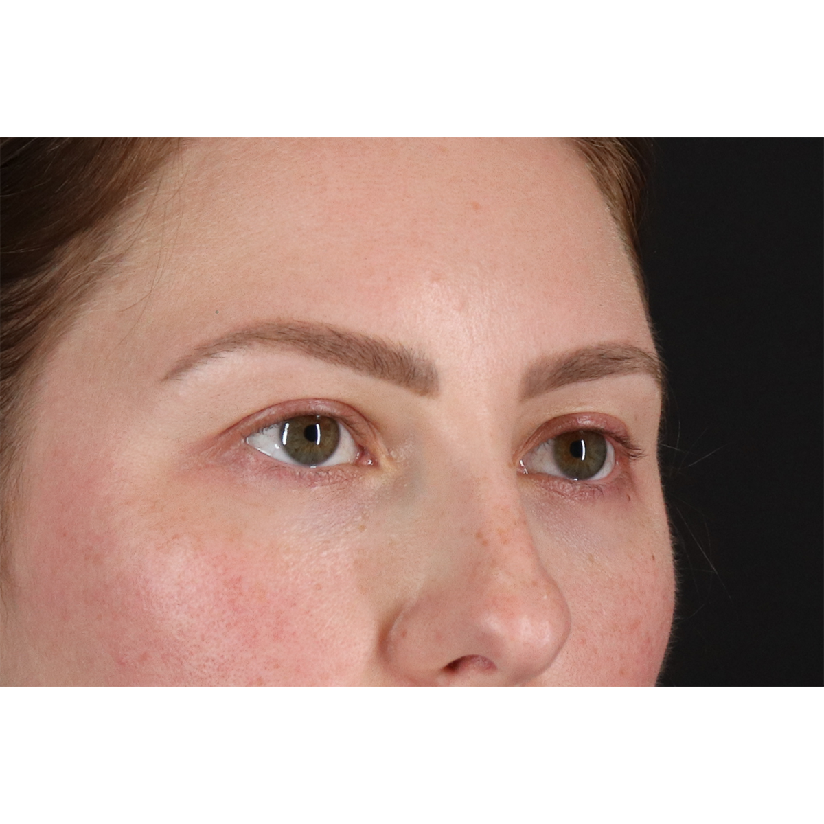 Brow Lift Before & After Patient #11657