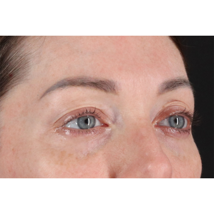 Blepharoplasty (Eyelid Surgery) Before & After Patient #11026