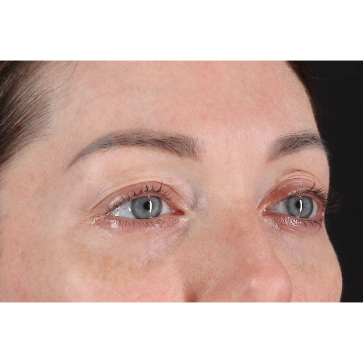 Blepharoplasty (Eyelid Surgery) Before & After Patient #11026