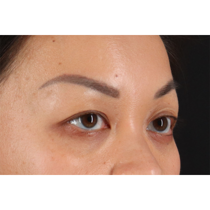 Blepharoplasty (Eyelid Surgery) Before & After Patient #11037