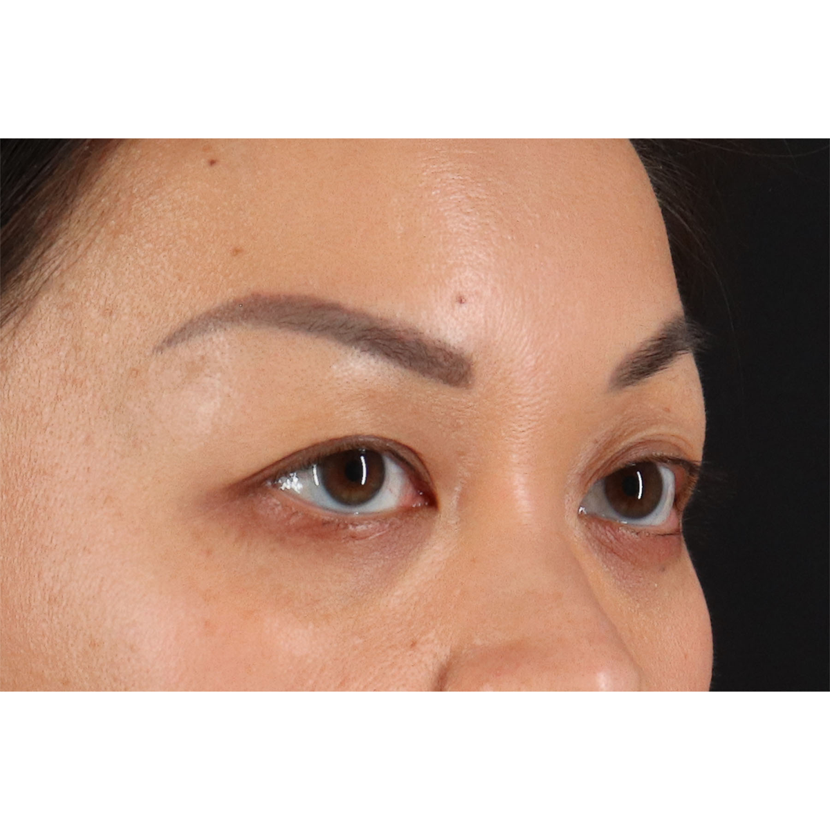 Blepharoplasty (Eyelid Surgery) Before & After Patient #11037