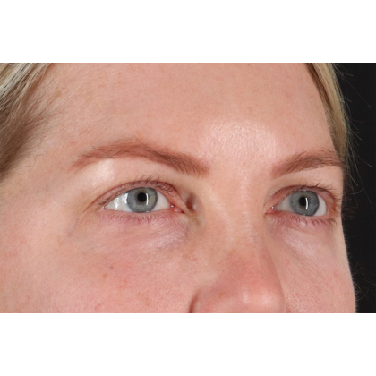 Blepharoplasty (Eyelid Surgery) Before & After Patient #11158