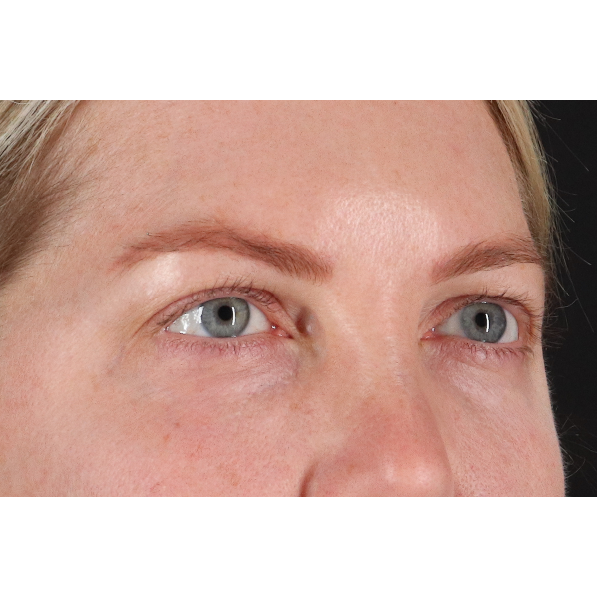 Blepharoplasty (Eyelid Surgery) Before & After Patient #11158