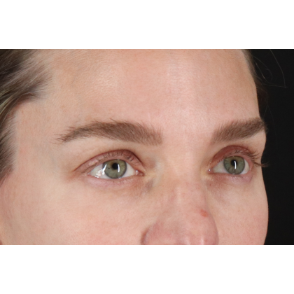 Blepharoplasty (Eyelid Surgery) Before & After Patient #11541