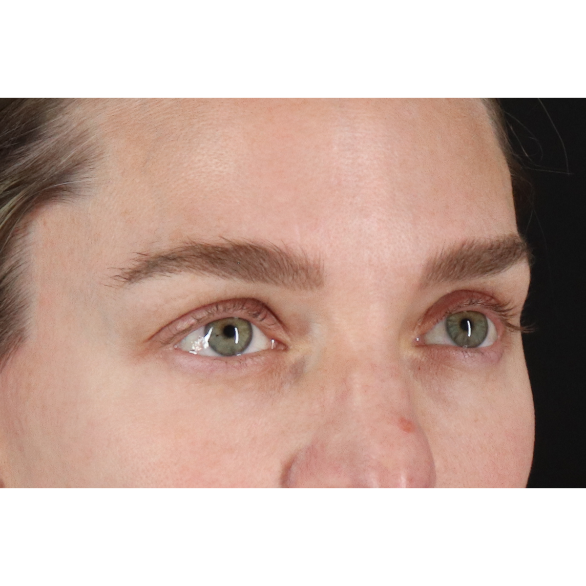 Blepharoplasty (Eyelid Surgery) Before & After Patient #11541