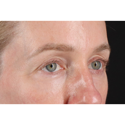 Blepharoplasty (Eyelid Surgery) Before & After Patient #11883