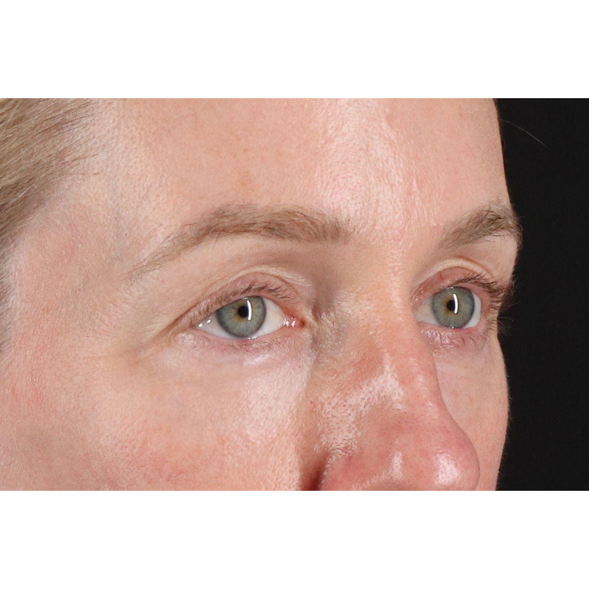 Blepharoplasty (Eyelid Surgery) Before & After Patient #11883
