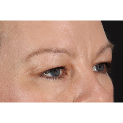 Blepharoplasty (Eyelid Surgery) Before & After Patient #11048