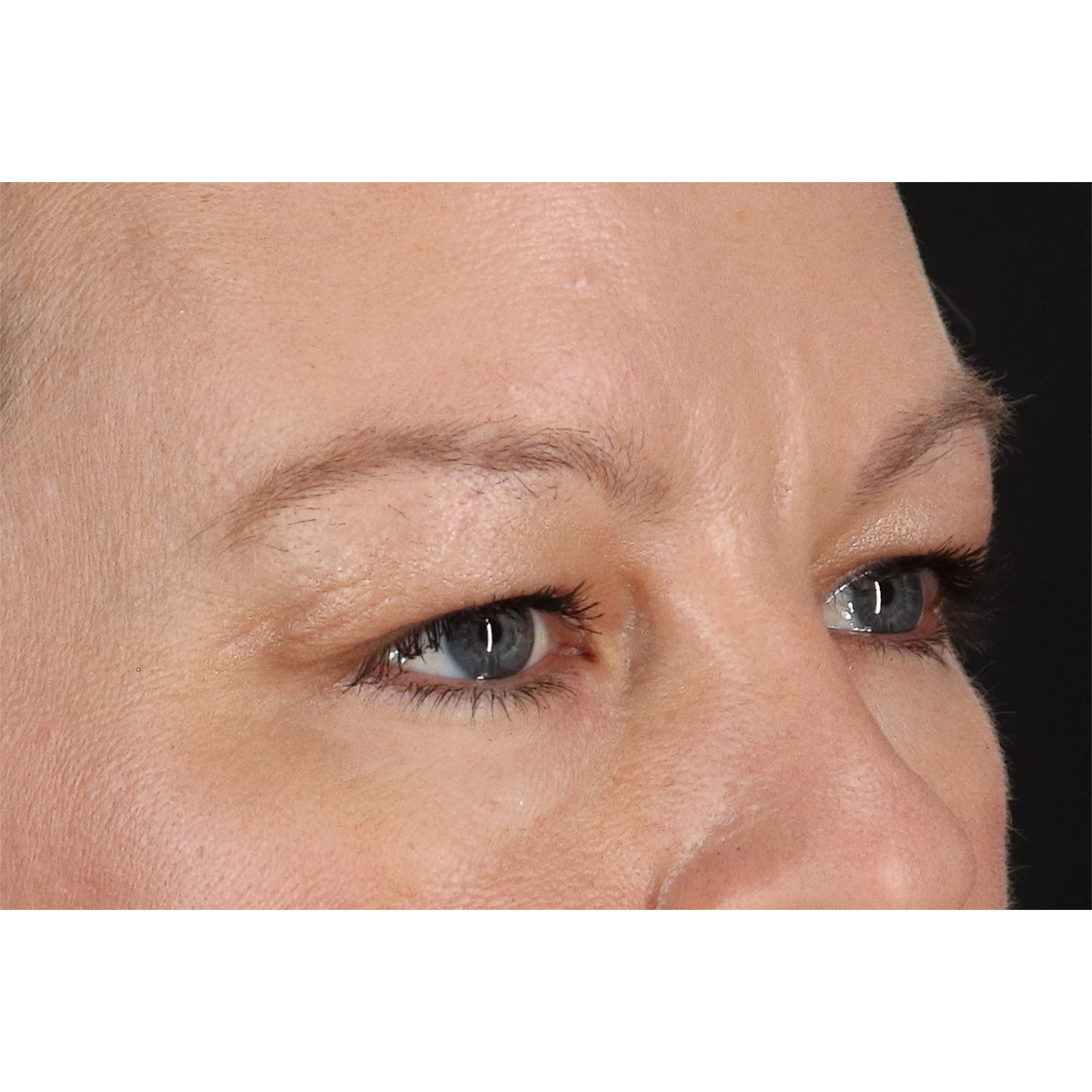 Blepharoplasty (Eyelid Surgery) Before & After Patient #11048
