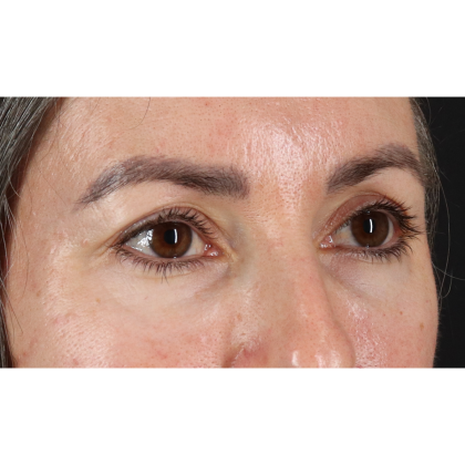 Blepharoplasty (Eyelid Surgery) Before & After Patient #11282