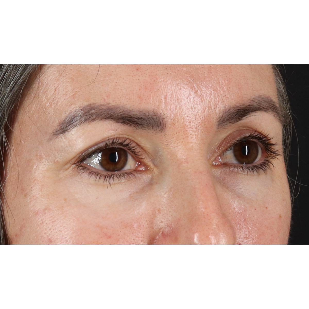 Blepharoplasty (Eyelid Surgery) Before & After Patient #11282