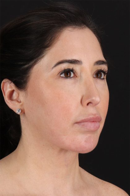 Fat Grafting To The Face Before & After Patient #11783