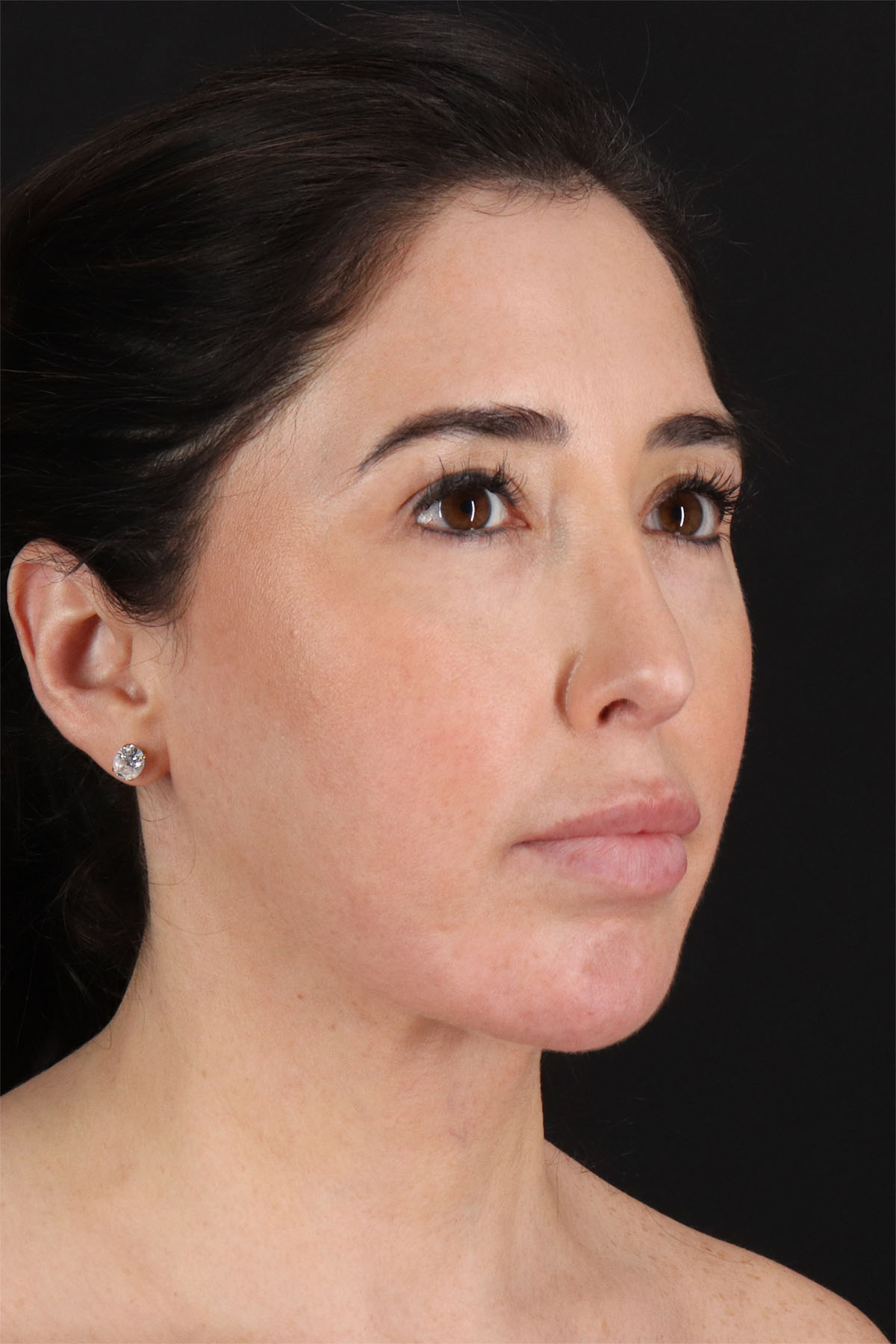 Fat Grafting To The Face Before & After Patient #11783