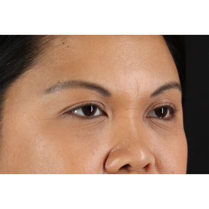 Brow Lift Before & After Patient #11646