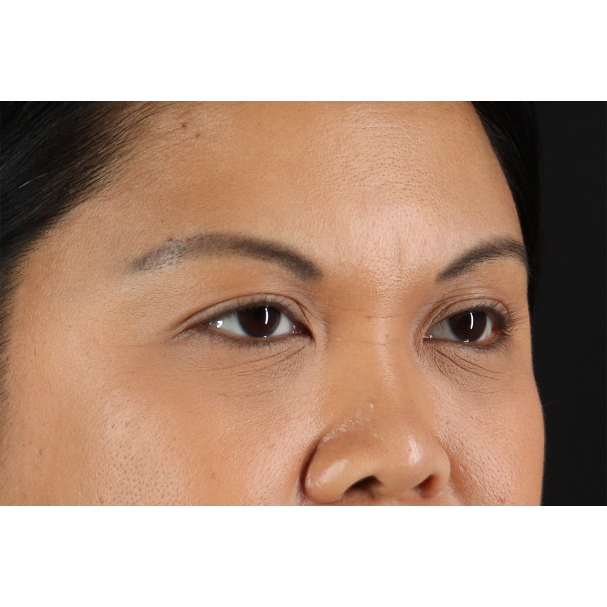 Brow Lift Before & After Patient #11646