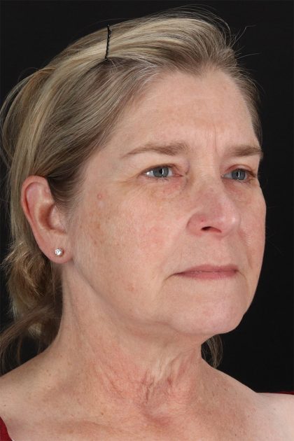 CO2 Laser Before & After Patient #11191