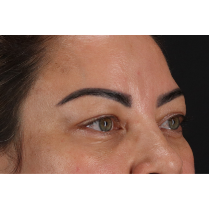 Blepharoplasty (Eyelid Surgery) Before & After Patient #11348