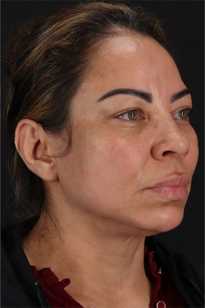 CO2 Laser Before & After Patient #11719