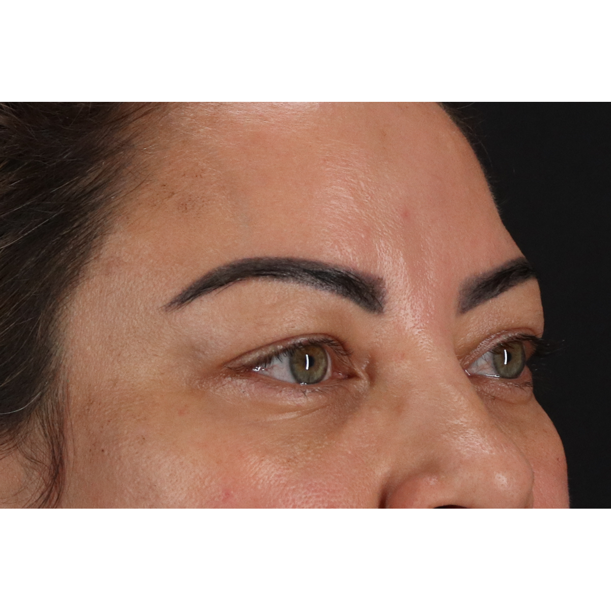 Blepharoplasty (Eyelid Surgery) Before & After Patient #11348