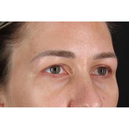 Blepharoplasty (Eyelid Surgery) Before & After Patient #11585