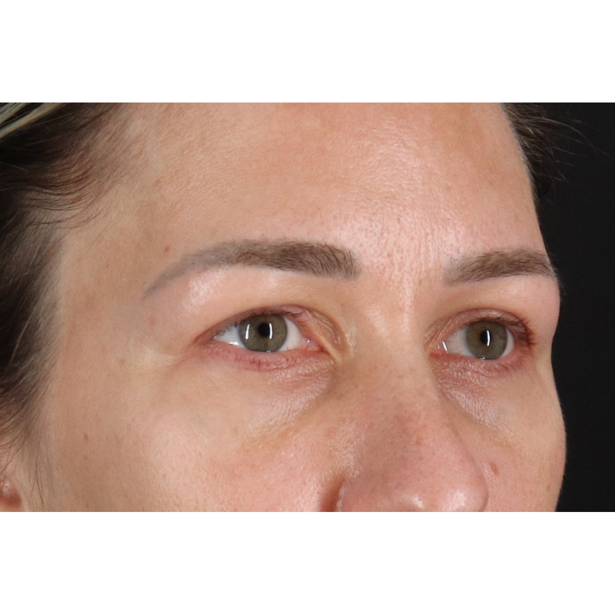 Blepharoplasty (Eyelid Surgery) Before & After Patient #11585