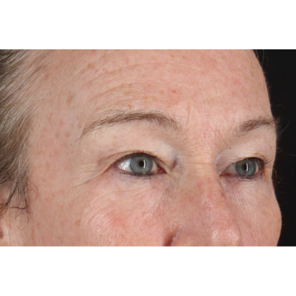 Blepharoplasty (Eyelid Surgery) Before & After Patient #11404