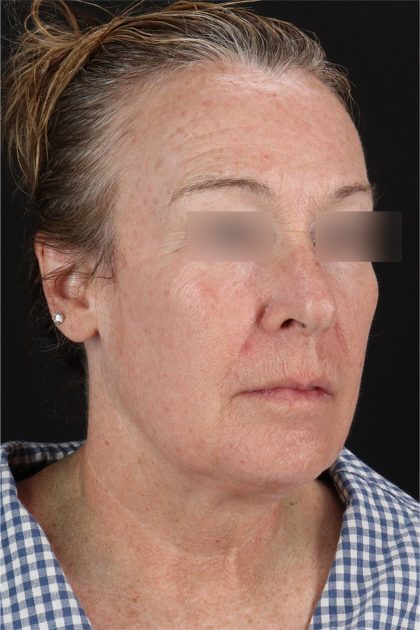 CO2 Laser Before & After Patient #11385