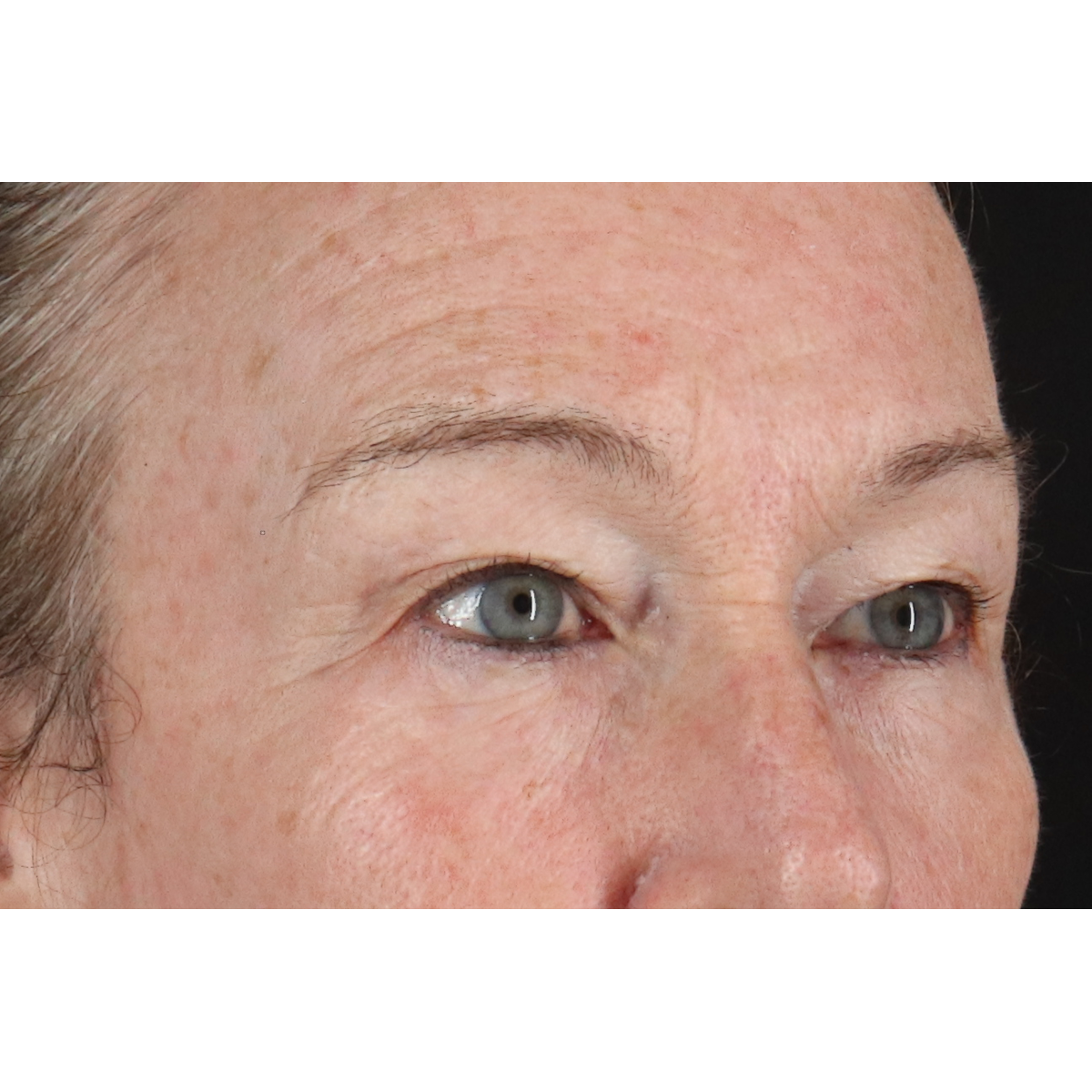 Blepharoplasty (Eyelid Surgery) Before & After Patient #11404
