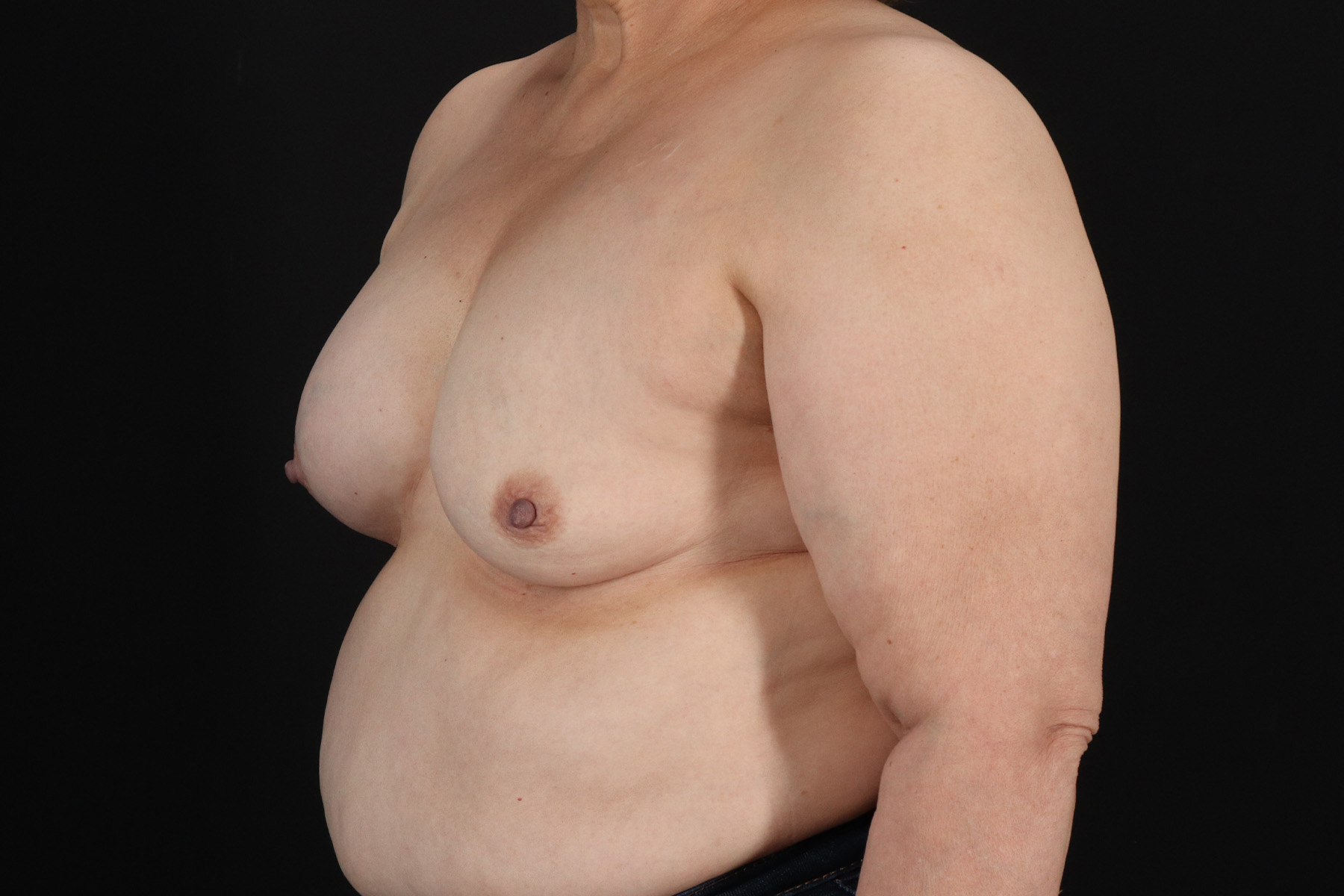 Breast Implant Exchange Before & After Patient #10537