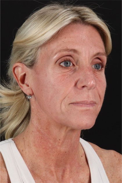 Fat Grafting To The Face Before & After Patient #11753