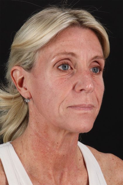 CO2 Laser Before & After Patient #11202