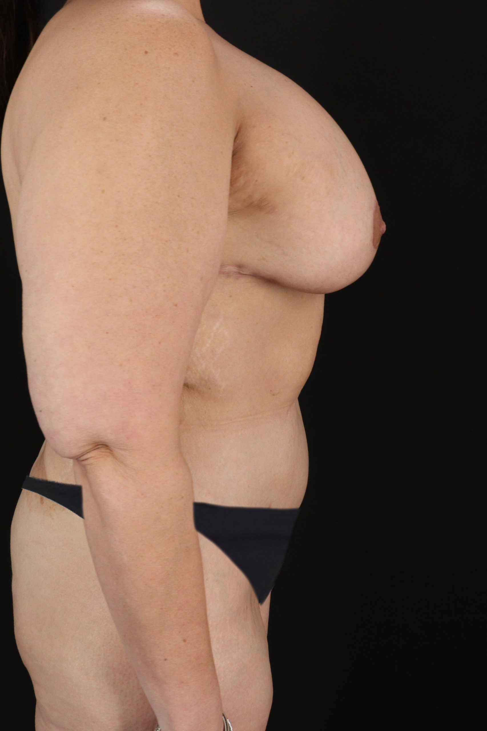 All Me Augmentation Before & After Patient #10290