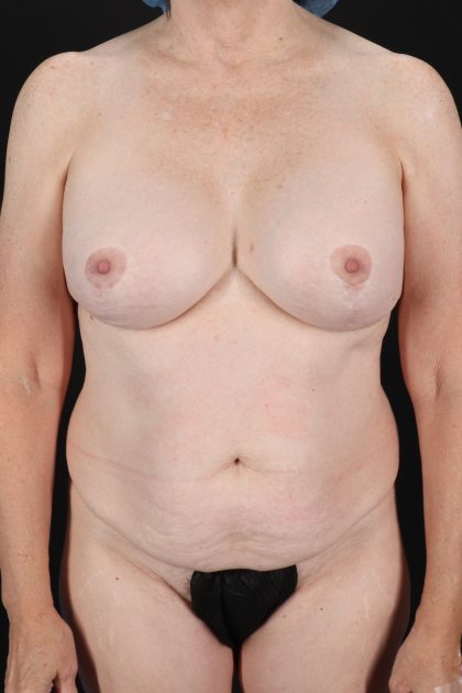 All Me Augmentation Before & After Patient #10273