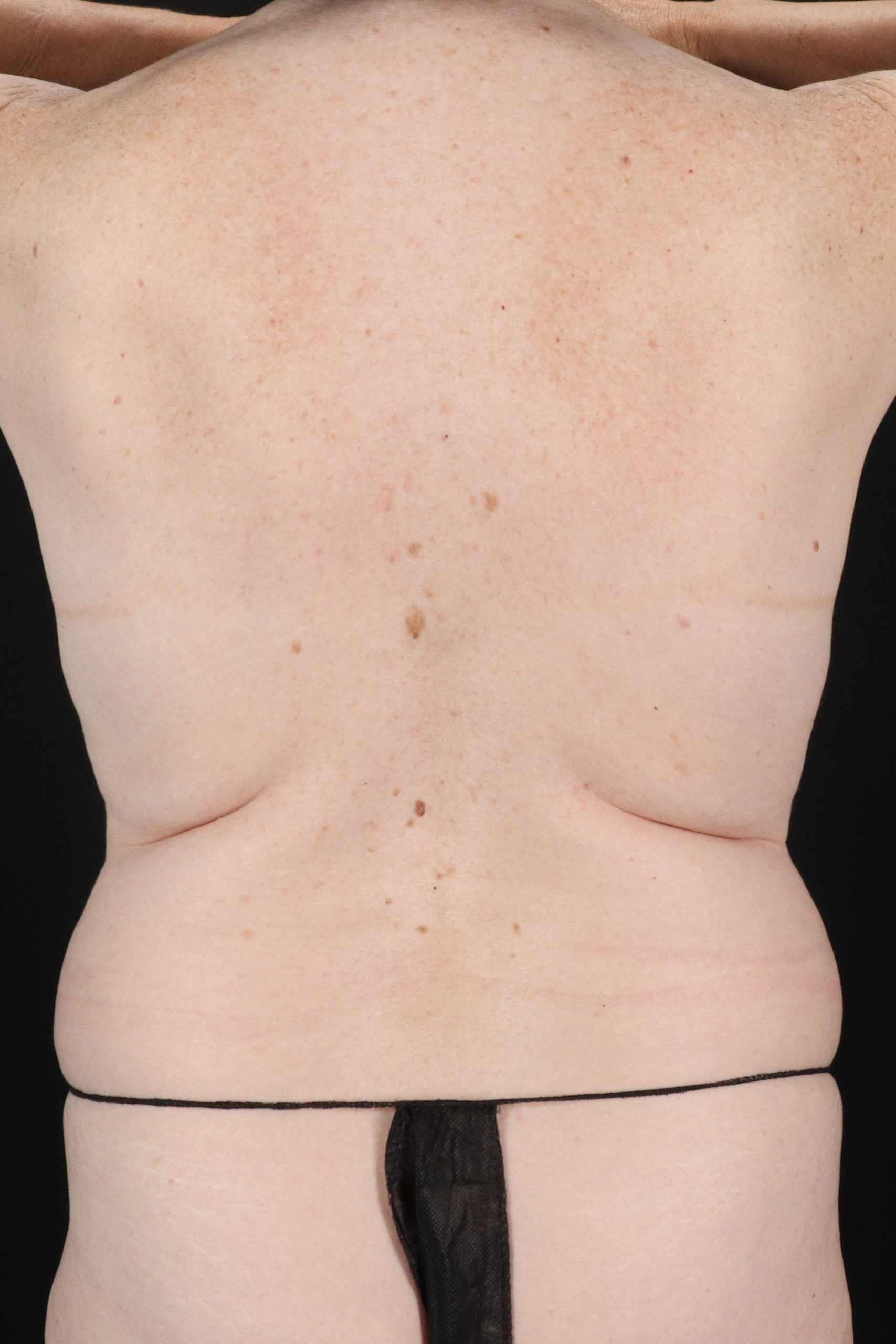 All Me Augmentation Before & After Patient #10273
