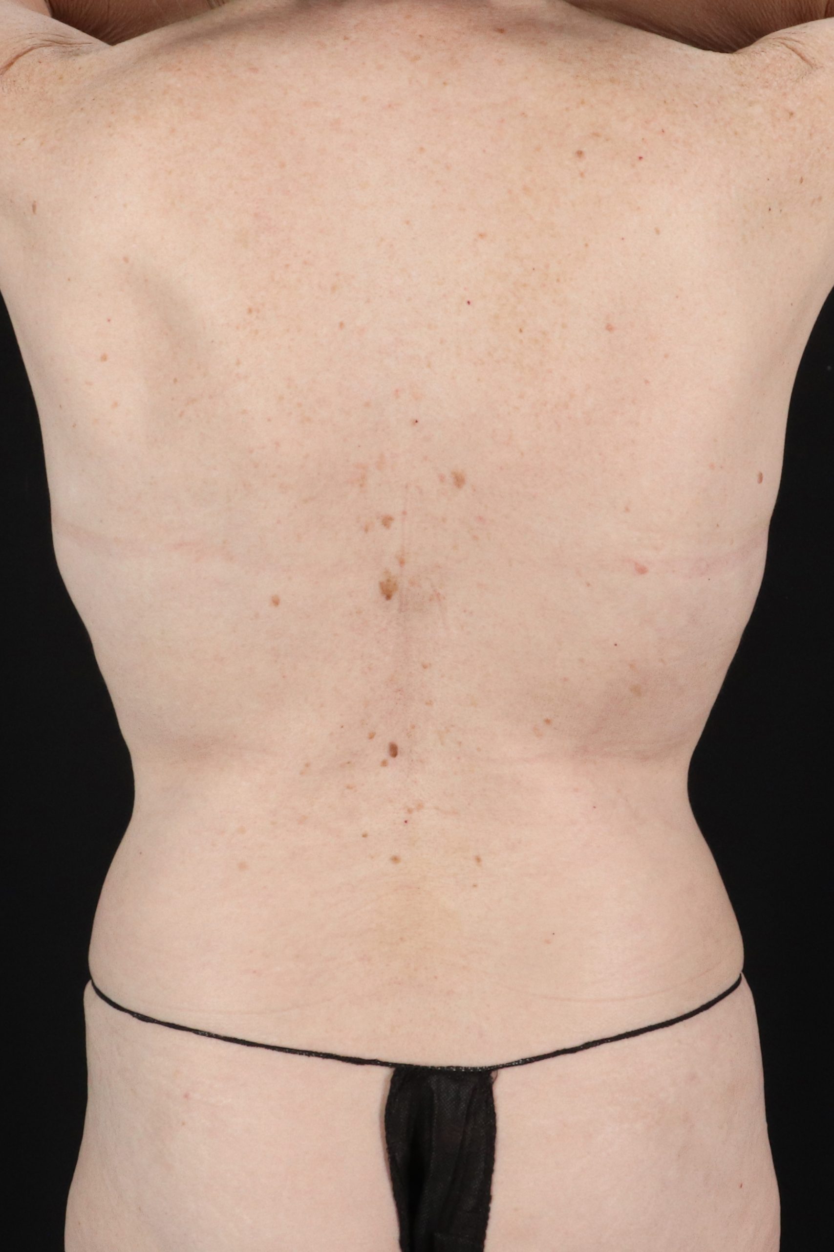 All Me Augmentation Before & After Patient #10273