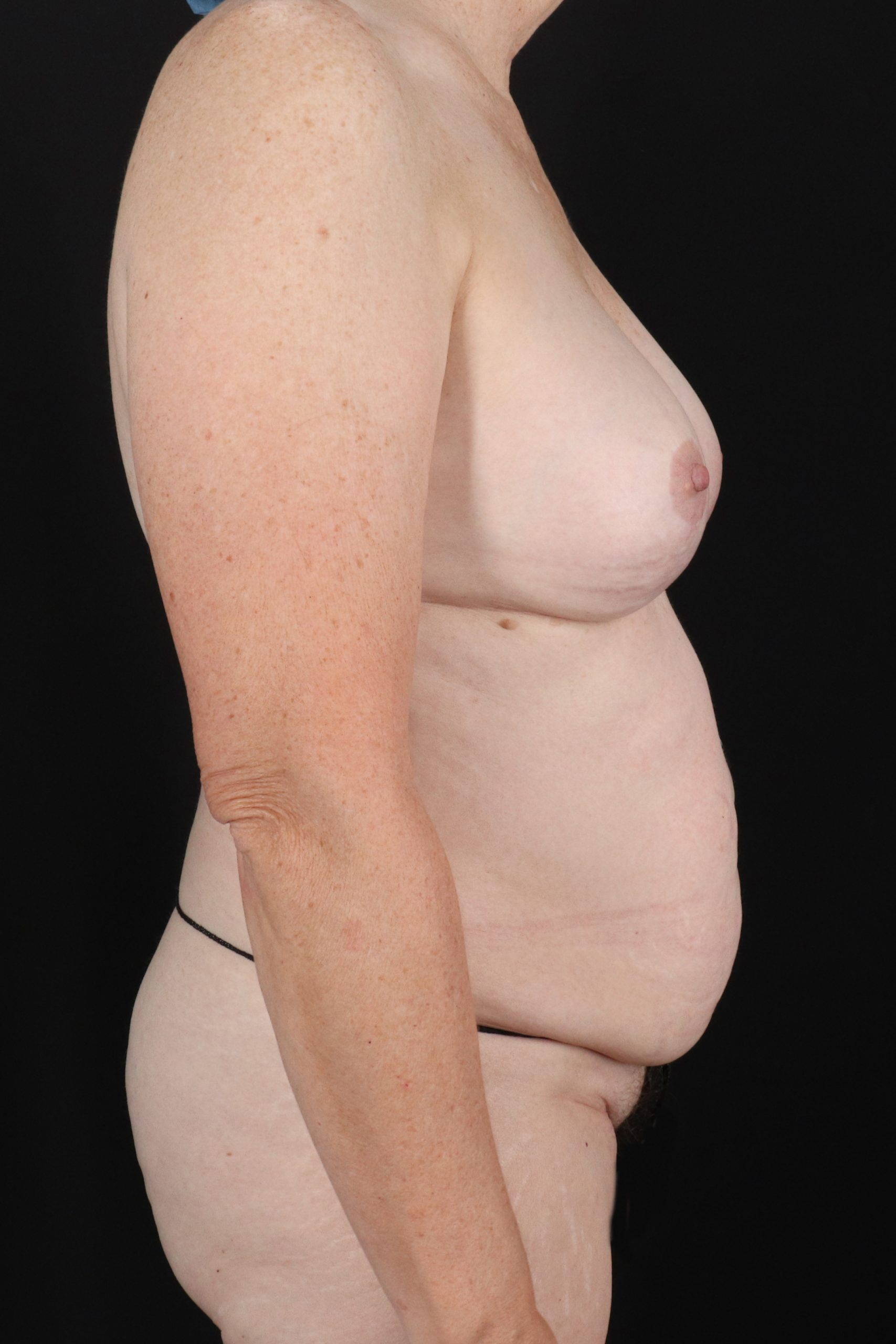 All Me Augmentation Before & After Patient #10273