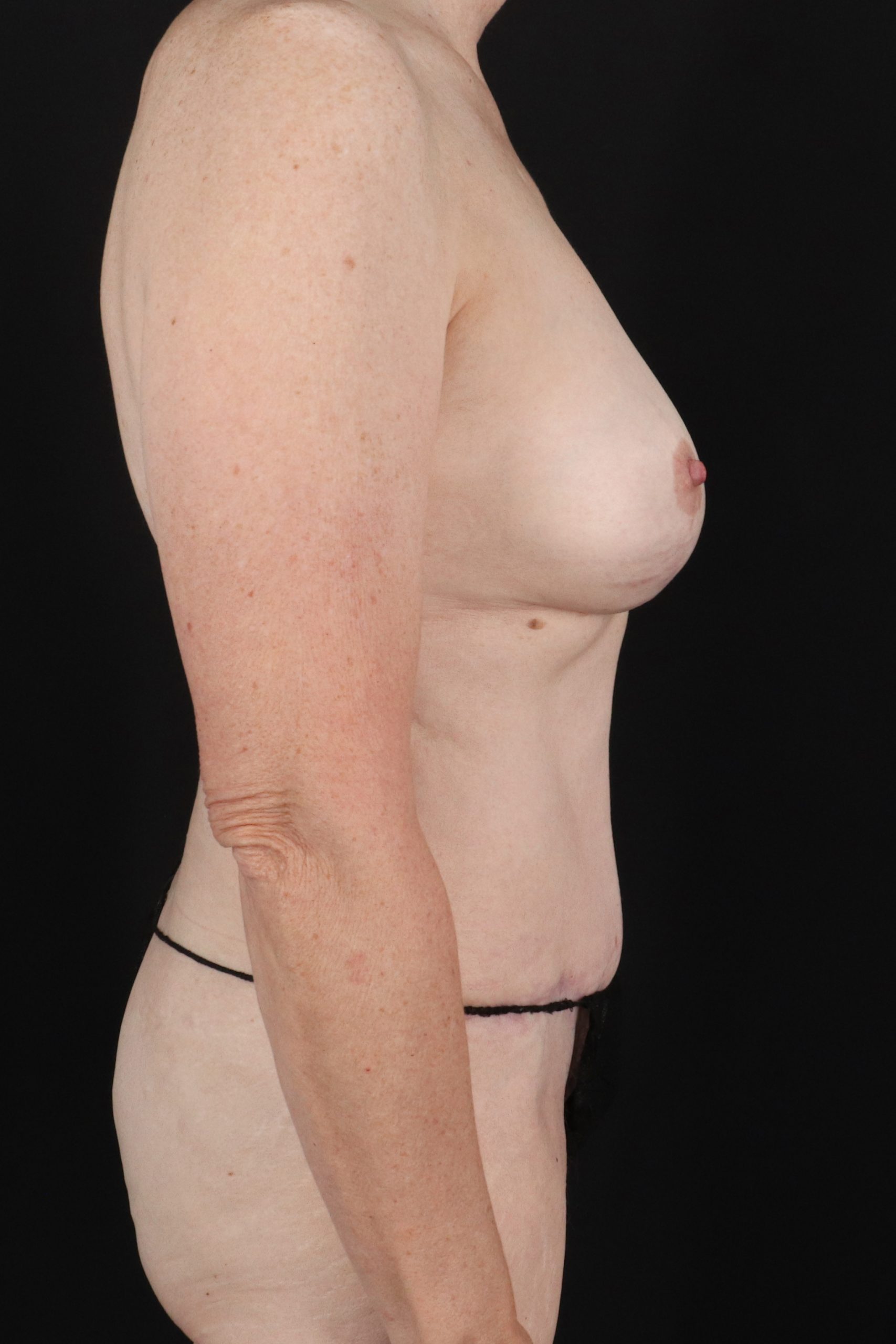 All Me Augmentation Before & After Patient #10273