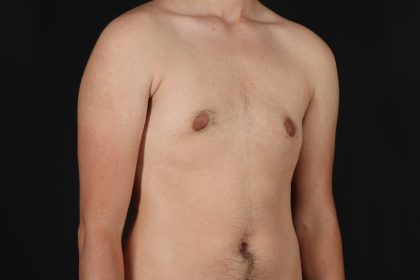 Female To Male Breast Before & After Patient #9981