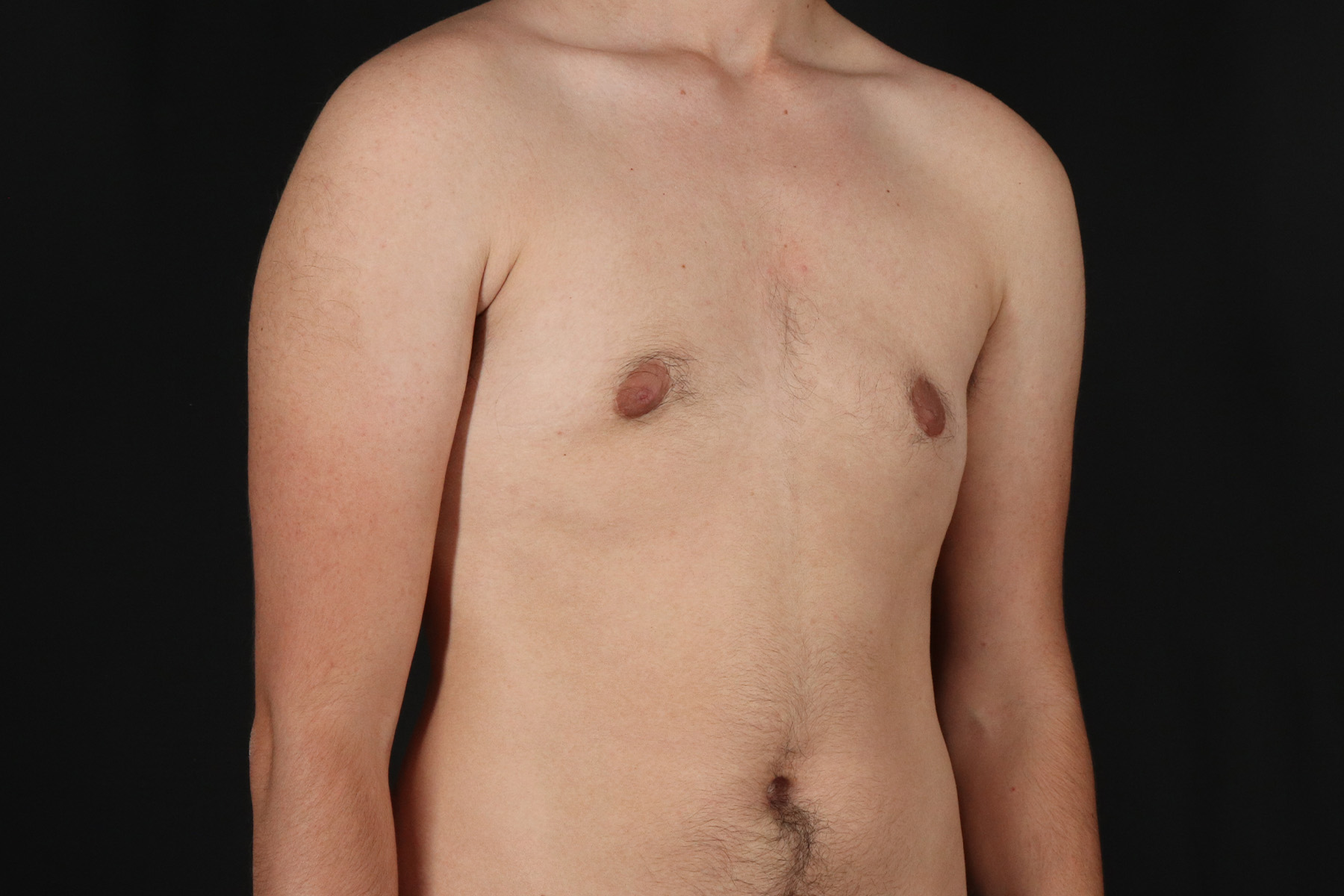 Female To Male Breast Before & After Patient #9981