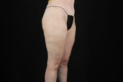 Quantum RF Before & After Patient #9984