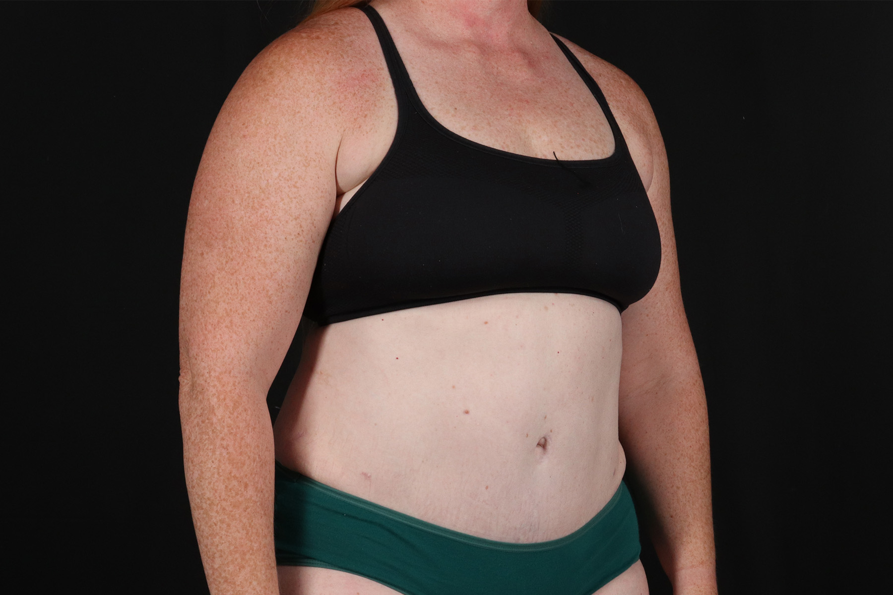 Abdominoplasty (Tummy Tuck) Before & After Patient #9980