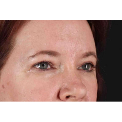 Brow Lift Before & After Patient #10859